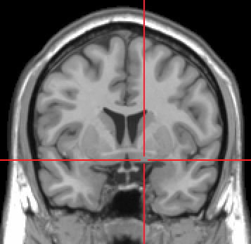 ファイル:Substantia innominata MRI.PNG