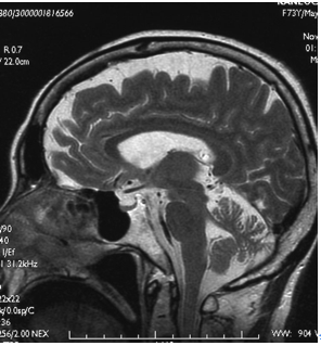 ファイル:脊髄小脳変性症2.png