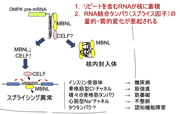 Inflammation of Spondyloarthropathy Illustration - 強直性脊椎炎の写真 強直性脊椎炎 (AS)