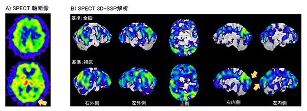 心臓への血流のイラスト 心臓の解剖学: 図、血流、機能