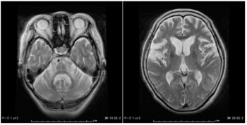 カンジダ症：原因と予防方法を理解する
