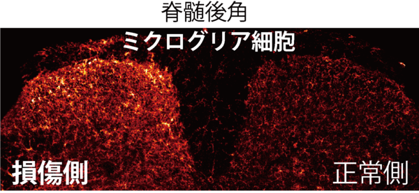 慢性的な肩の涙 腱板断裂と損傷