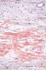 ファイル:Cardiac amyloidosis high mag.jpgのサムネイル