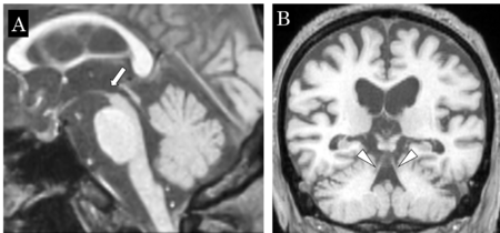 腺癌 腺癌は進行性の癌ですか?