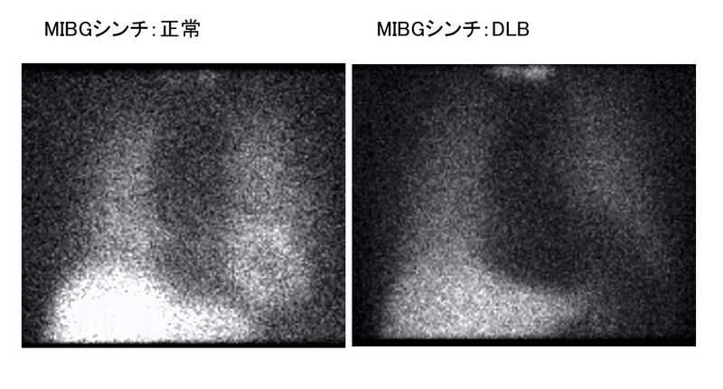 ファイル:Nagahama Dementia with Lewie Bodies Fig2.jpg